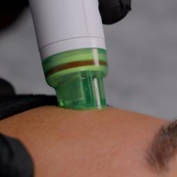 Volderm SPONGE sejas procedūra